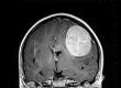Could My Headache Mean a Brain Tumour?