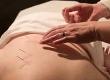 I Had Acupuncture for Migraine: A Case Study
