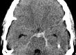 What is a Subarachnoid Haemorrhage?