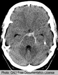 Subarachnoid Haemorrhage Bleeding In The