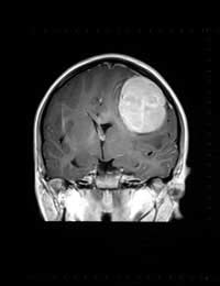 Brain Tumour Cancer Headache Symptoms