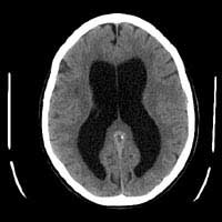 Hydrocephalus Headaches Viral Meningitis