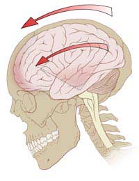 Concussion Headache Unconscious Skull